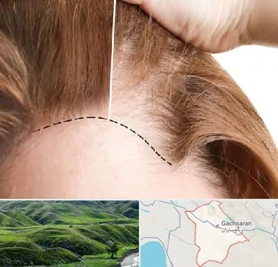 کاشت مو برای خانمها در گچساران