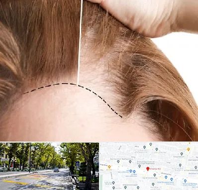 کاشت مو برای خانمها در میرداماد 