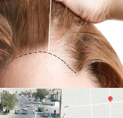 کاشت مو برای خانمها در هاشمی