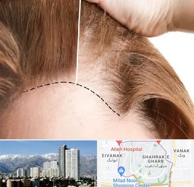 کاشت مو برای خانمها در شهرک غرب 