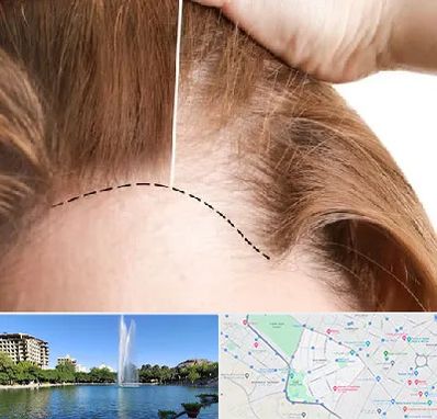 کاشت مو برای خانمها در کوهسنگی مشهد