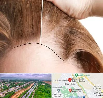 کاشت مو برای خانمها در قصرالدشت شیراز
