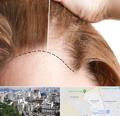 کاشت مو برای خانمها در ولنجک 