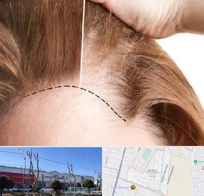 کاشت مو برای خانمها در فاز دو اندیشه