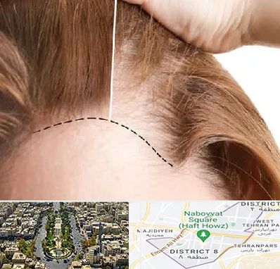 کاشت مو برای خانمها در نارمک 