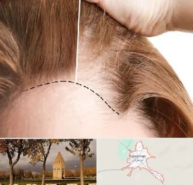 کاشت مو برای خانمها در تویسرکان