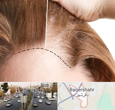 کاشت مو برای خانمها در باقرشهر