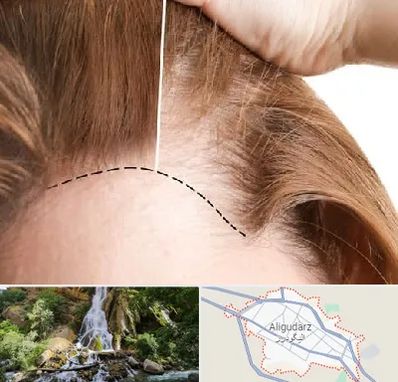 کاشت مو برای خانمها در الیگودرز