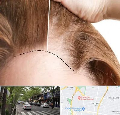 کاشت مو برای خانمها در ظفر 