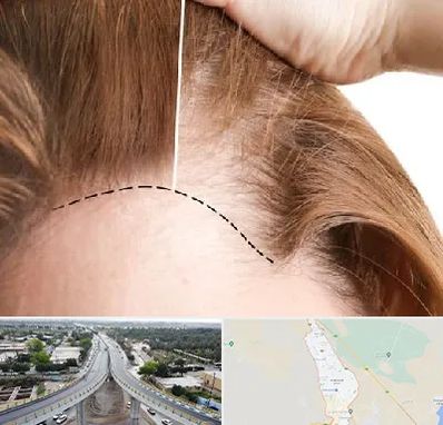 کاشت مو برای خانمها در اندیمشک