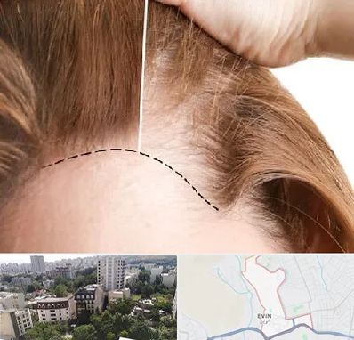 کاشت مو برای خانمها در اوین