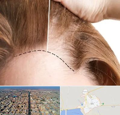 کاشت مو برای خانمها در بندر ماهشهر