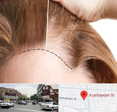 کاشت مو برای خانمها در خیابان آذربایجان