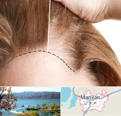کاشت مو برای خانمها در مریوان