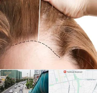 کاشت مو برای خانمها در بلوار فرحزادی
