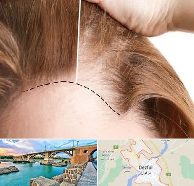 کاشت مو برای خانمها در دزفول