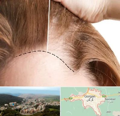 کاشت مو برای خانمها در گرگان