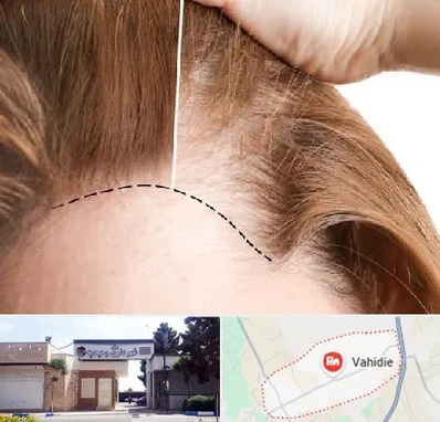 کاشت مو برای خانمها در وحیدیه شهریار