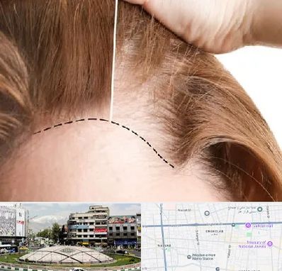 کاشت مو برای خانمها در مرکز تهران