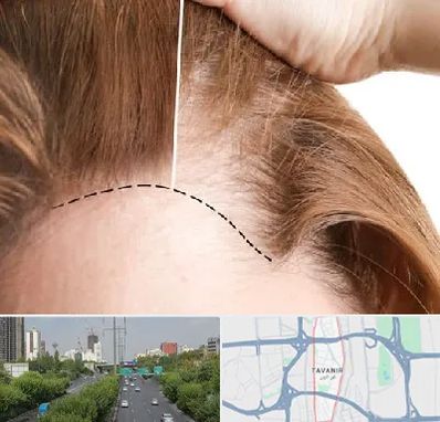 کاشت مو برای خانمها در توانیر