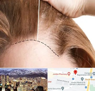 کاشت مو برای خانمها در جردن 