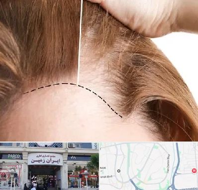 کاشت مو برای خانمها در ایران زمین