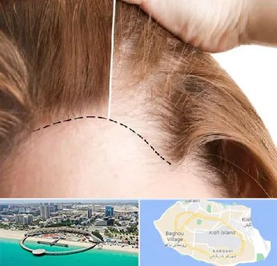 کاشت مو برای خانمها در کیش