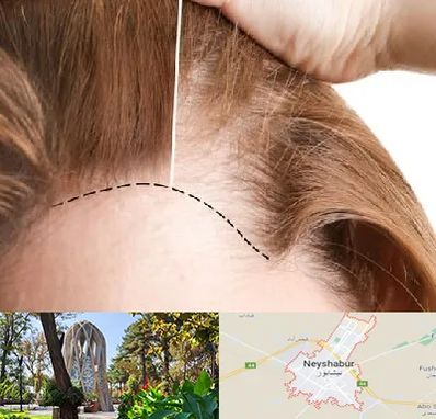 کاشت مو برای خانمها در نیشابور