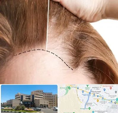 کاشت مو برای خانمها در صیاد شیرازی مشهد