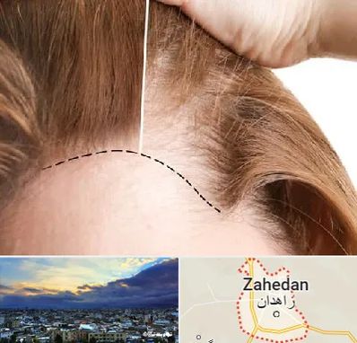 کاشت مو برای خانمها در زاهدان