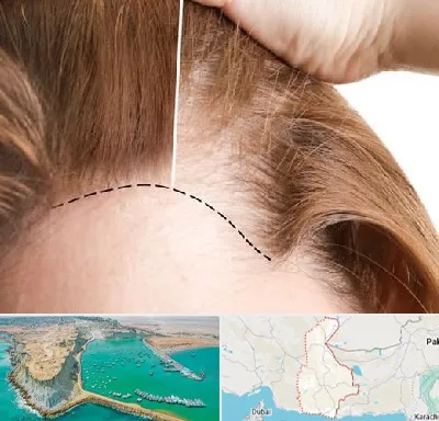 کاشت مو برای خانمها در سیستان و بلوچستان