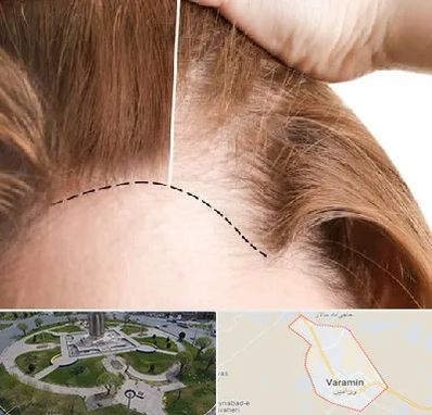 کاشت مو برای خانمها در ورامین