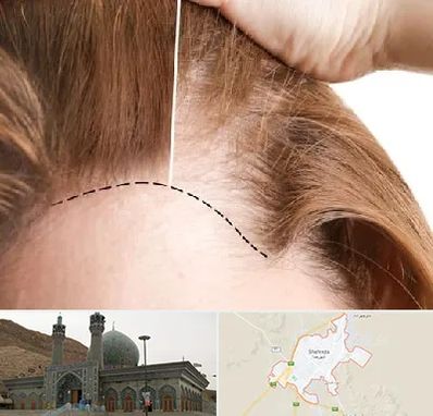 کاشت مو برای خانمها در شهرضا