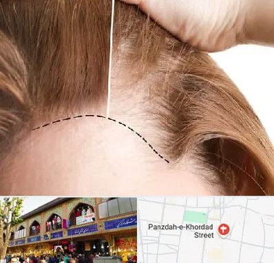 کاشت مو برای خانمها در 15 خرداد