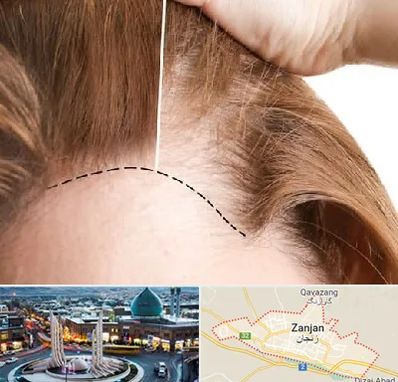 کاشت مو برای خانمها در زنجان