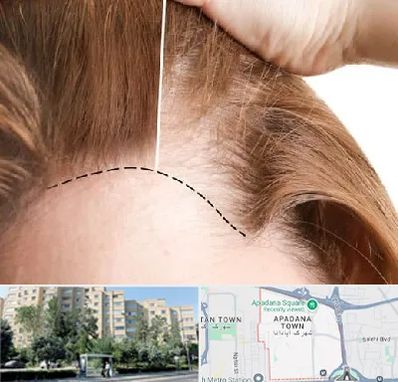 کاشت مو برای خانمها در آپادانا