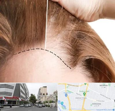 کاشت مو برای خانمها در بلوار فردوس 