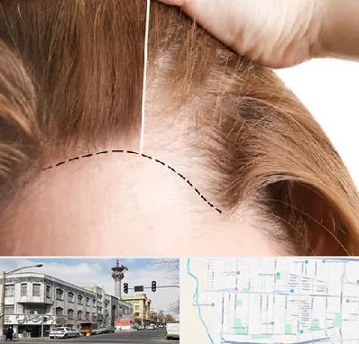 کاشت مو برای خانمها در 17شهریور