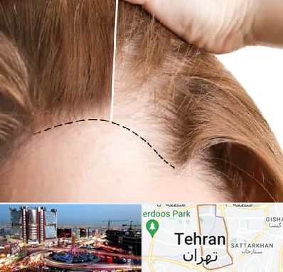 کاشت مو برای خانمها در صادقیه 