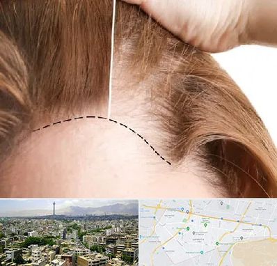 کاشت مو برای خانمها در منطقه 8 تهران 