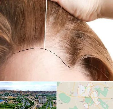 کاشت مو برای خانمها در شهریار