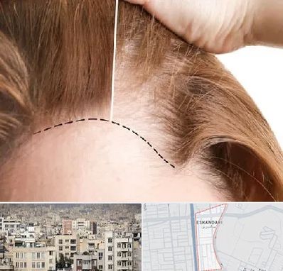 کاشت مو برای خانمها در اسکندری