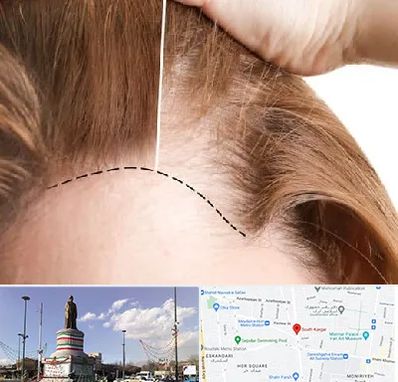 کاشت مو برای خانمها در کارگر جنوبی 