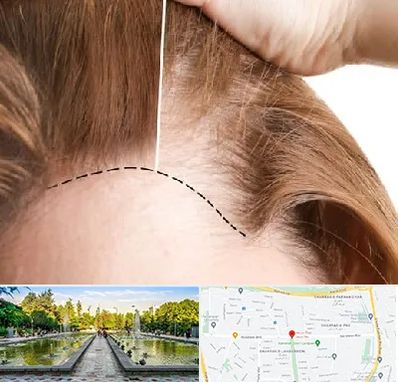 کاشت مو برای خانمها در سرسبز 