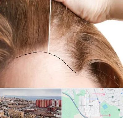 کاشت مو برای خانمها در سهند تبریز