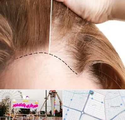 کاشت مو برای خانمها در پادادشهر اهواز