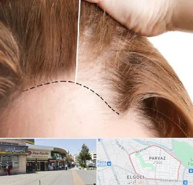 کاشت مو برای خانمها در پرواز تبریز