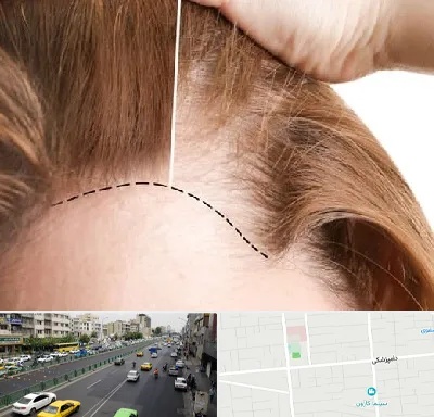کاشت مو برای خانمها در خیابان دامپزشکی