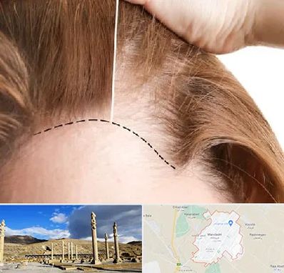 کاشت مو برای خانمها در مرودشت