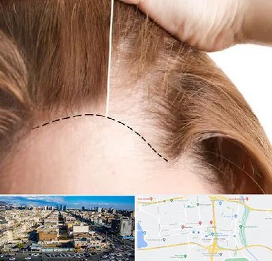 کاشت مو برای خانمها در شهرک راه آهن